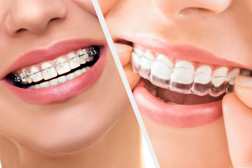 Difference between Braces and Invisalign – Best Dentist and Dental Clinic  Near you